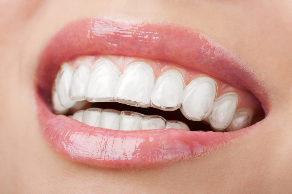 Een doorzichtige Invisalign-aligner over de boventanden