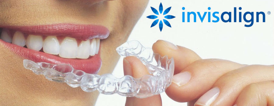 Transparante Invisalign-aligner voor een behandeling in Utrecht
